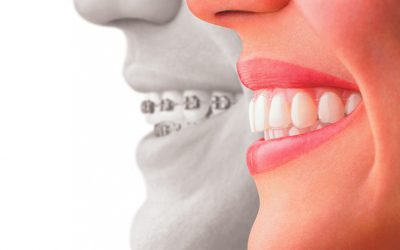 La ortodoncia invisible, un gran avance